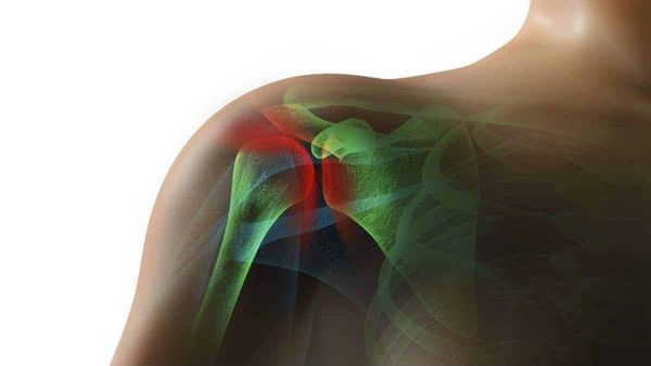 Rotator Cuff Injury